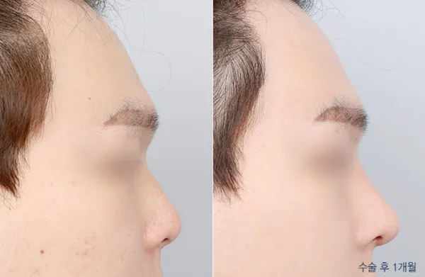Before/After