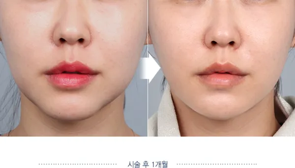 Before/After
