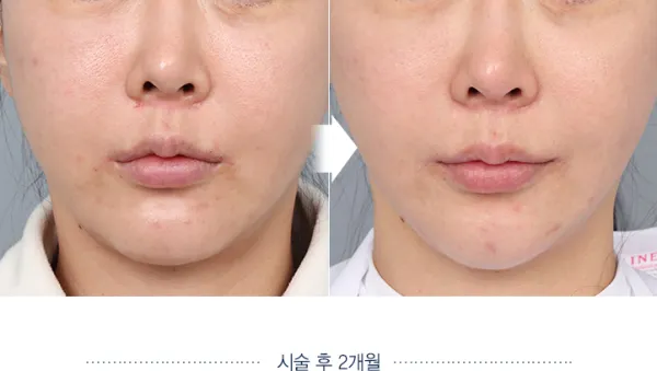 Before/After