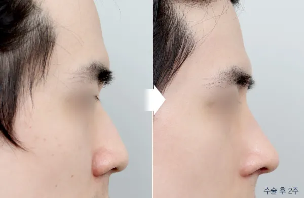 Before/After