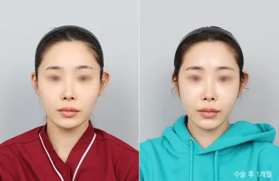 Before & After