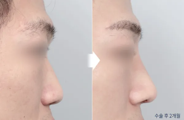 Before/After
