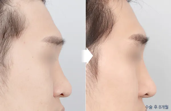Before/After