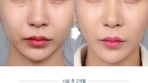 Before/After