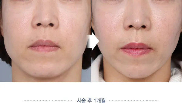 Before/After
