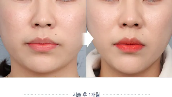 Before/After