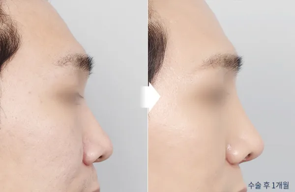 Before/After