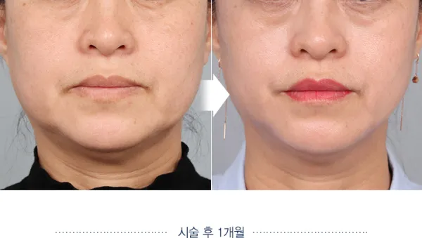 Before/After