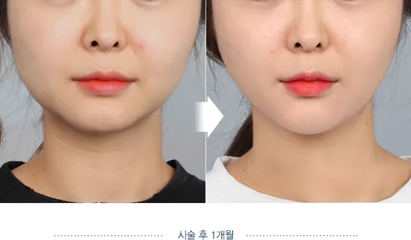 Before/After