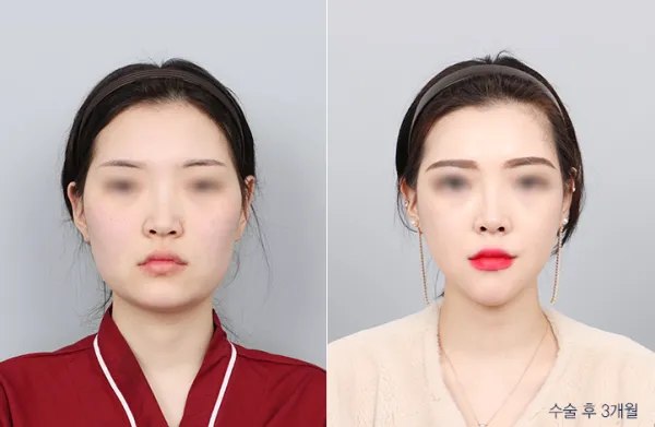 Before/After