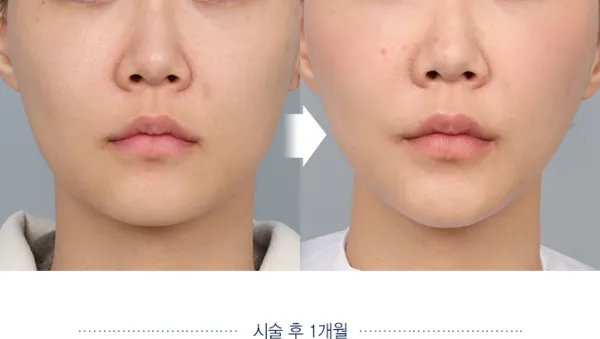 Before/After