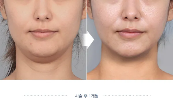 Before/After