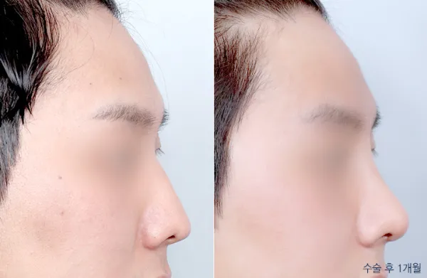 Before/After