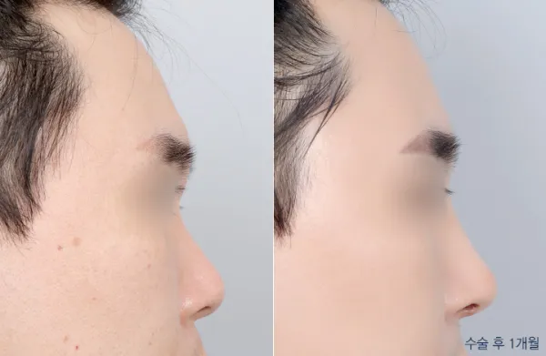 Before/After