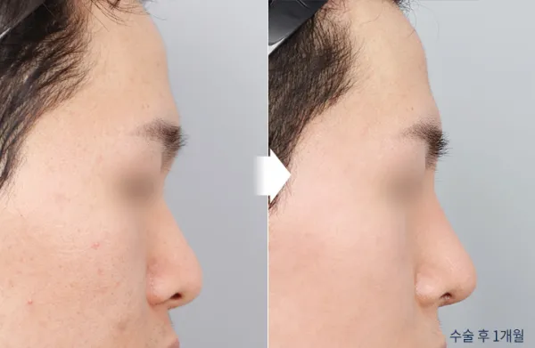 Before/After