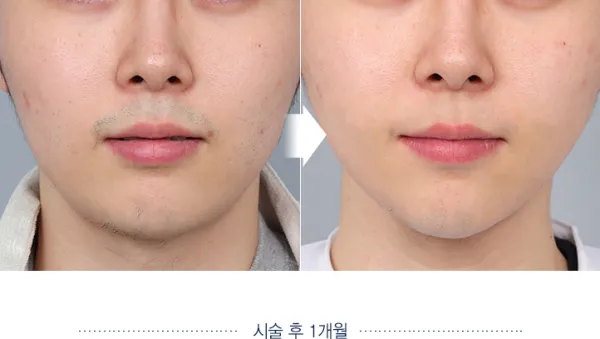 Before/After