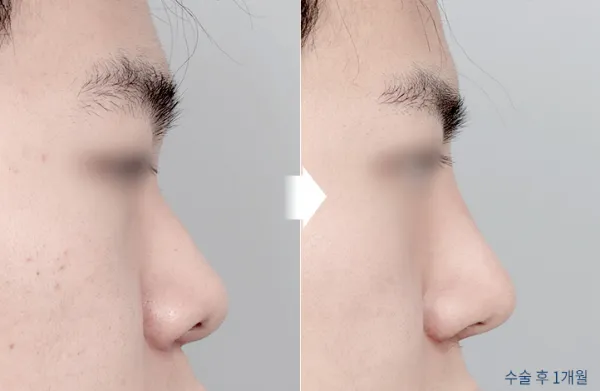 Before/After