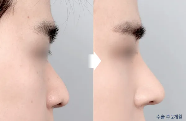 Before/After