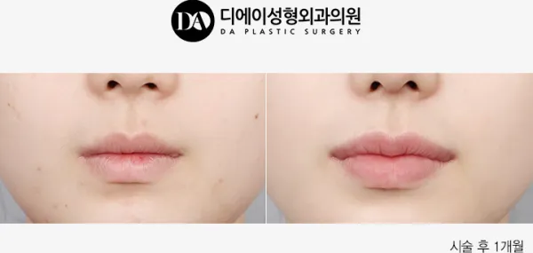 Before/After