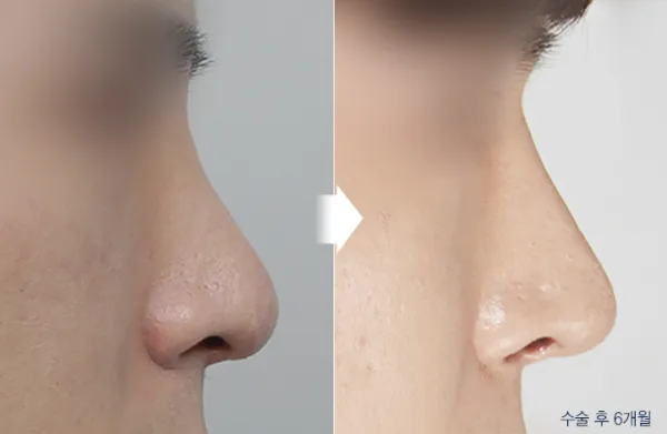 Before/After