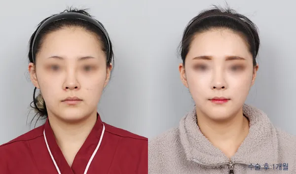 Before/After