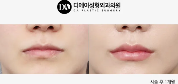 Before/After