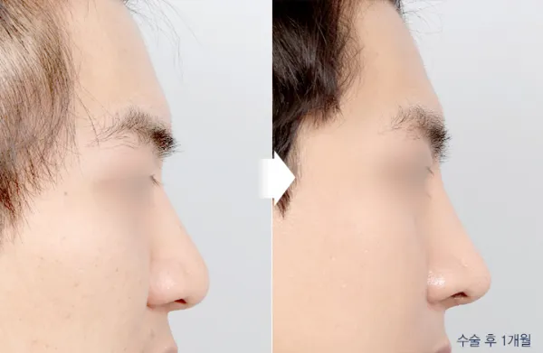 Before/After