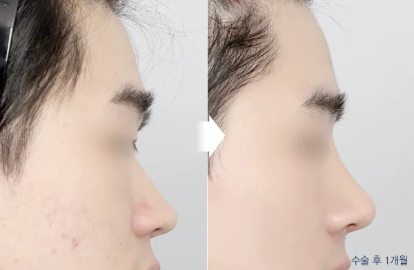 Before/After