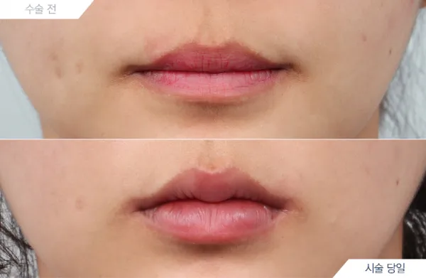 Before/After