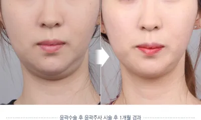 Before & After