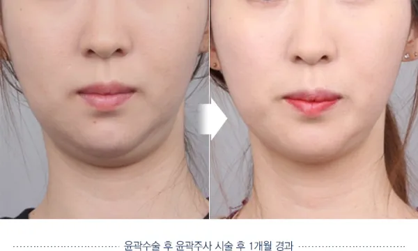 Before/After