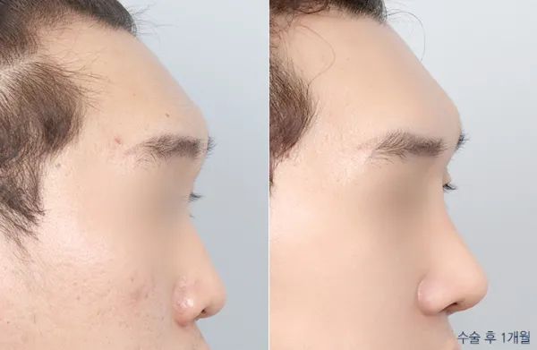 Before/After