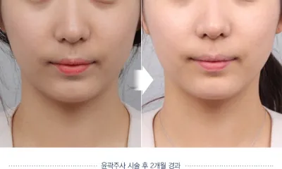 Before & After