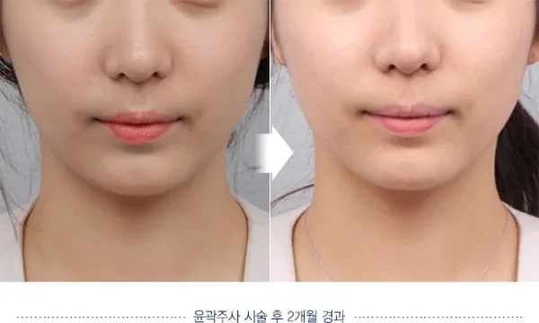 Before/After