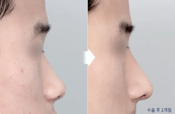 Before/After