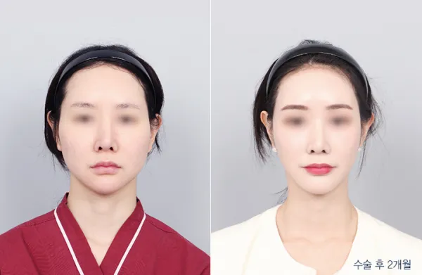 Before/After