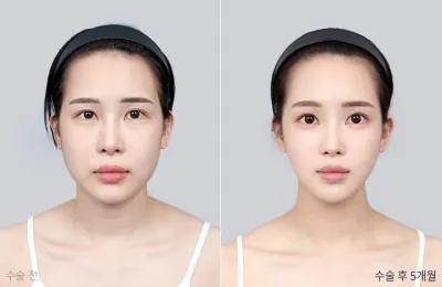 Before & After