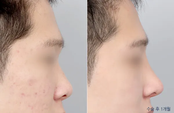 Before/After