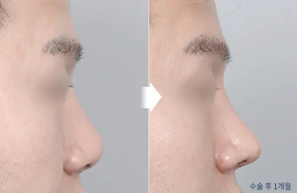Before/After