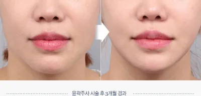 Before & After