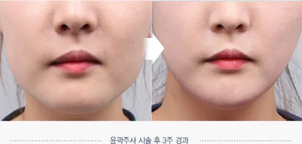 Before/After