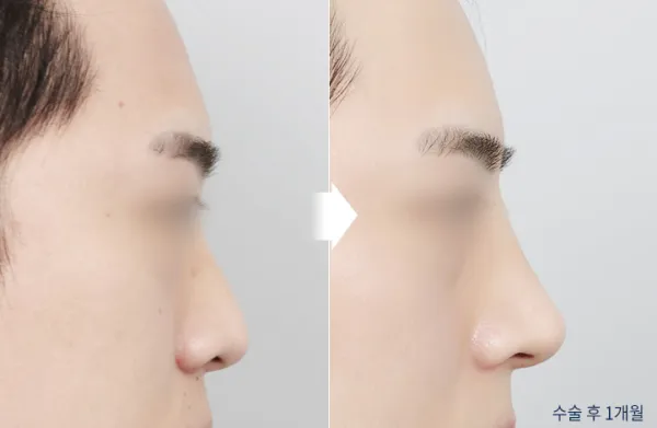 Before/After
