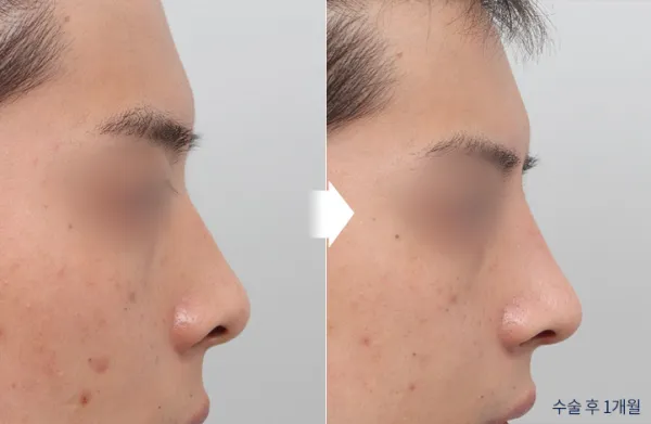 Before/After