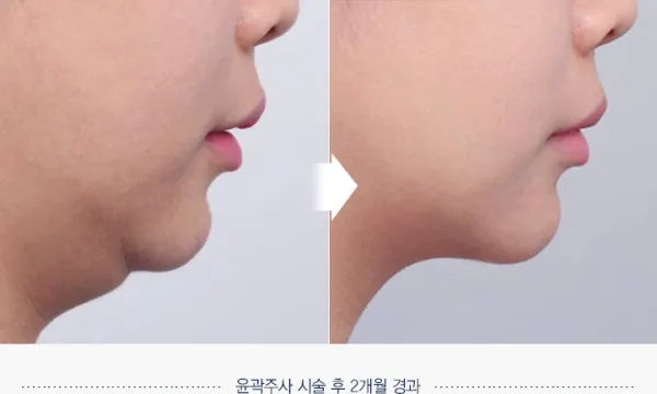 Before/After