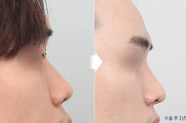 Before/After