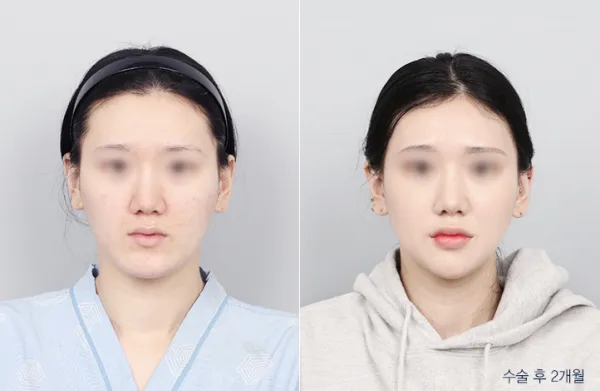Before/After