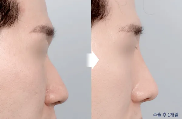 Before/After
