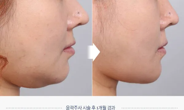 Before/After