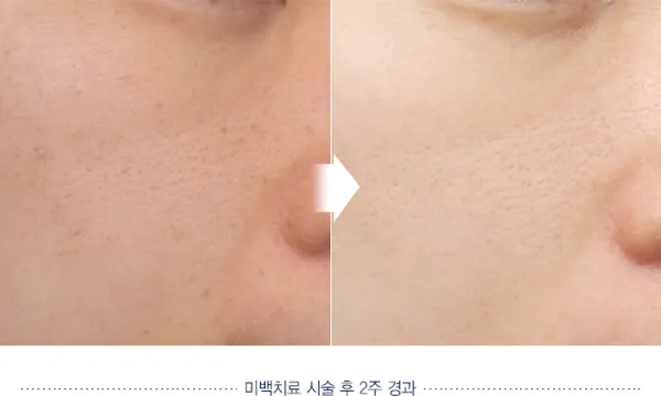 Before/After