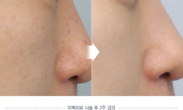 Before/After